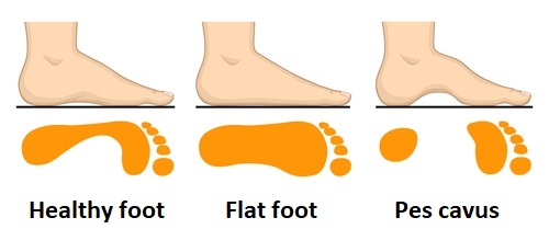 A high instep may be a symptom of pes cavus - The Original Foot ...